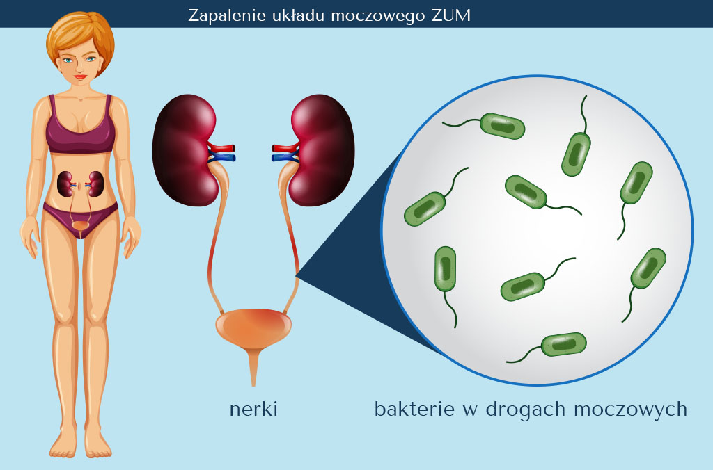 alkaptonuria pieluchy