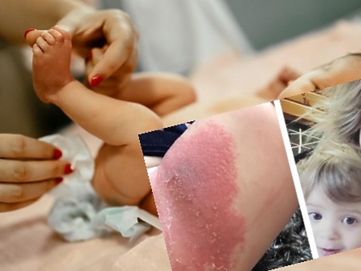 chusteczki nawilżane dada naturals reakcja alergiczna